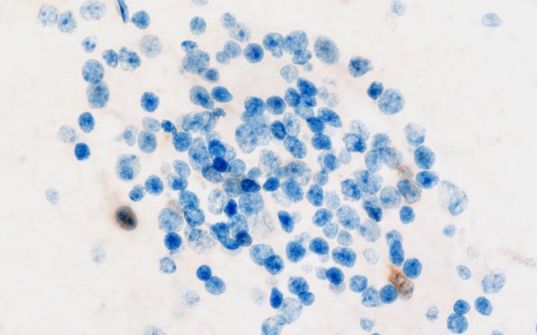 5I6 Malformation (Case 5) NeuN 100X 3