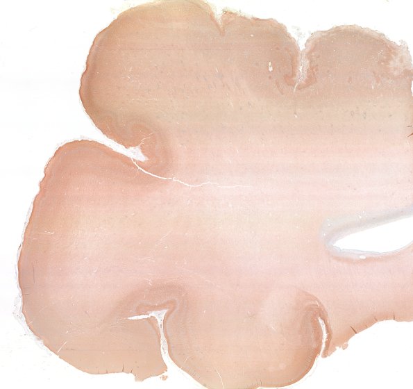 5J1 Malformation (Case 5) SYN WM