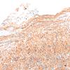5J2 Malformation (Case 5) SYN 20X 4