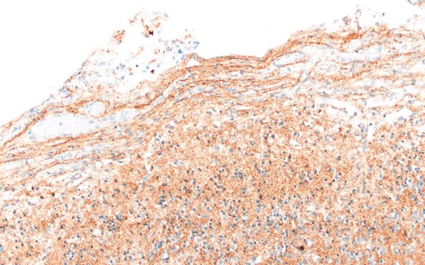 5J2 Malformation (Case 5) SYN 20X 4