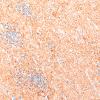 5J3 Malformation (Case 5)  SYN 20X 3