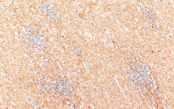 5J3 Malformation (Case 5)  SYN 20X 3