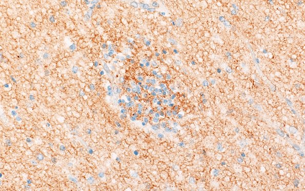 5J4  Malformation (Case 5) SYN 40X 4