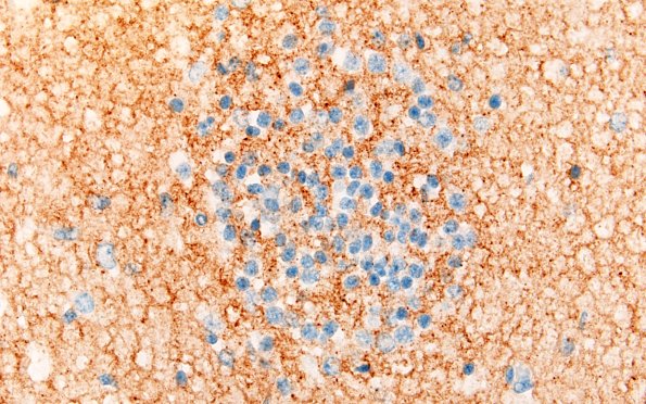 5J5 Malformation (Case 5) SYN 60X 3