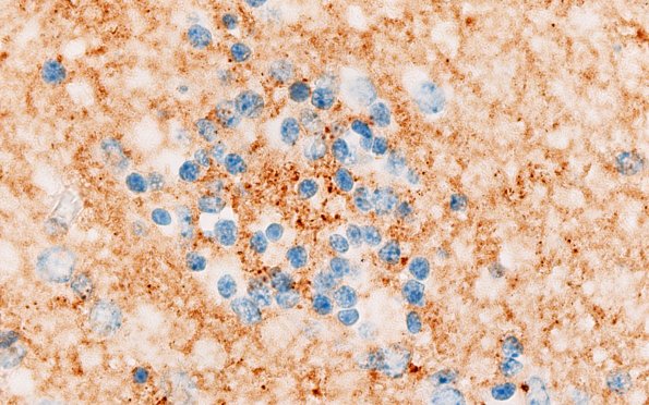5J7 Malformation (Case 5) SYN 100X 6