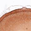 5K1A Malformation (Case 5) Calretinin 4X 2