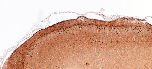 5K1A Malformation (Case 5) Calretinin 4X 2
