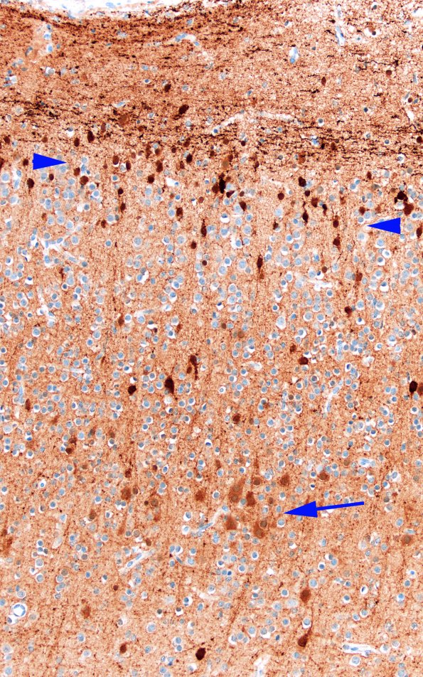 5K1B Malformation (Case 5) Calretinin 20X 6 copy