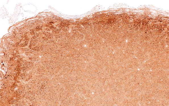 5K1C Malformation (Case 5) Calretinin 4X
