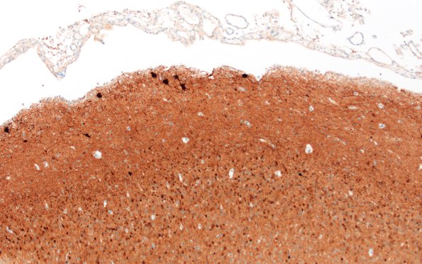 5K1D Malformation (Case 5) Calretinin  10X 1