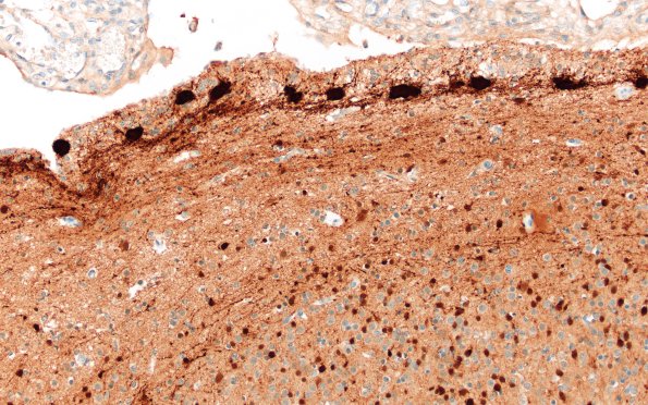 5K1E Malformation (Case 5) Calretinin  20X 1