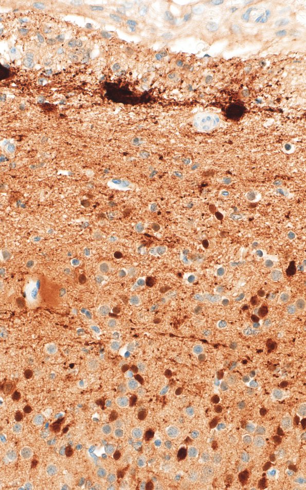 5K1F Malformation (Case 5) Calretinin  40X 1