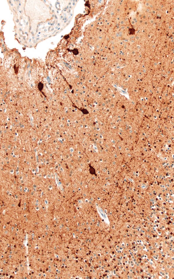 5K1G Malformation (Case 5) Calretinin 20X 1