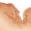 5K2A Malformation (Case 5) Calretinin 2X 1