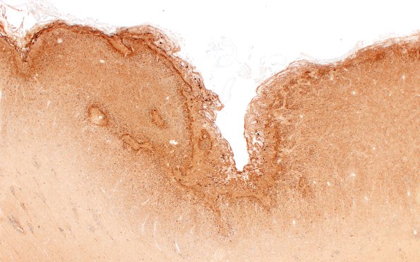 5K2A Malformation (Case 5) Calretinin 2X 1