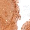 5K2B Malformation (Case 5) Calretinin 4X 3