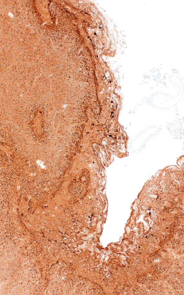 5K2B Malformation (Case 5) Calretinin 4X 3