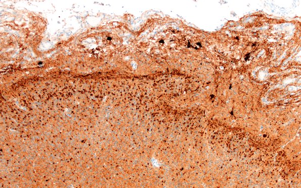 5K2C Malformation (Case 5) Calretinin 10X 1