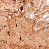 5K2D Malformation (Case 5) Calretinin  20X 2