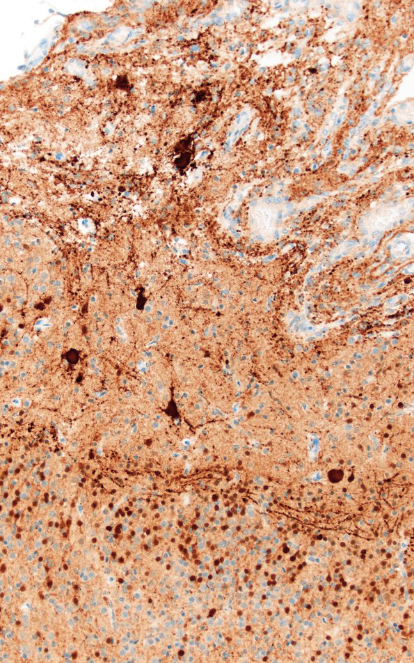 5K2D Malformation (Case 5) Calretinin  20X 2