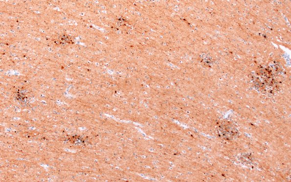 5K3A Malformation (Case 5) Calretinin 10X 4