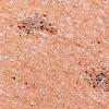 5K3B Malformation (Case 5) Calretinin 20X 7
