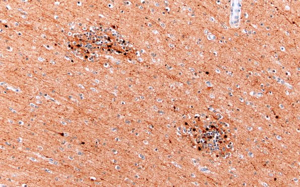 5K3B Malformation (Case 5) Calretinin 20X 7