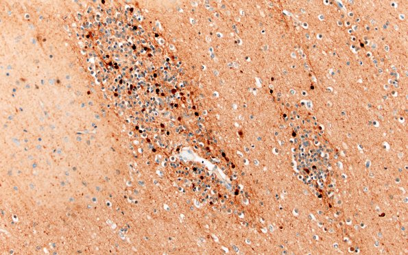 5K3C Malformation (Case 5) Calretinin 20X 3