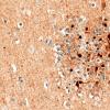 5K3D Malformation (Case 5) Calretinin 40X 4
