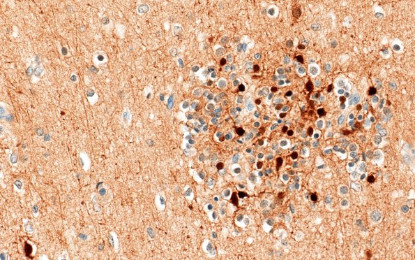 5K3D Malformation (Case 5) Calretinin 40X 4