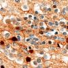 5K3E Malformation (Case 5) Calretinin 100X