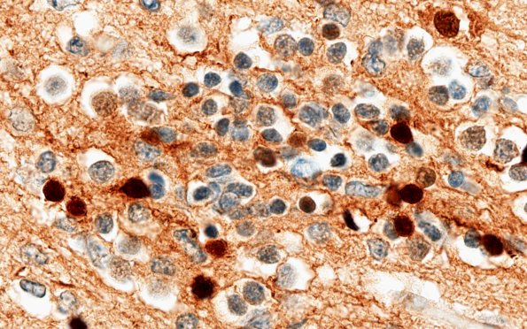 5K3E Malformation (Case 5) Calretinin 100X