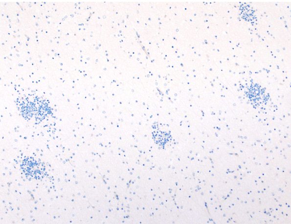 5L1 Malformation (Case 5) TTF 10X