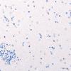 5L2 Malformation (Case 5) TTF 20X
