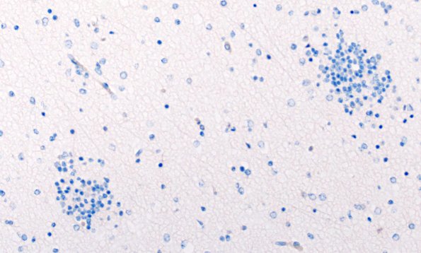 5L2 Malformation (Case 5) TTF 20X