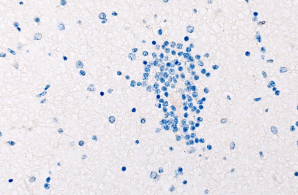 5L3 Malformation (Case 5) TTF 40X