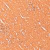 5M1 Malformation (Case 5) CD56 20X 1
