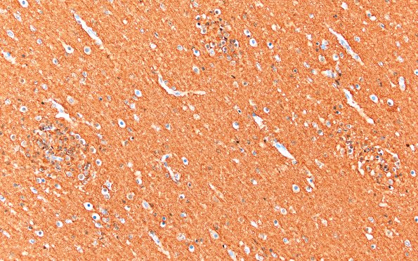 5M1 Malformation (Case 5) CD56 20X 1