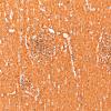 5M2 Malformation (Case 5) CD56 20X 2