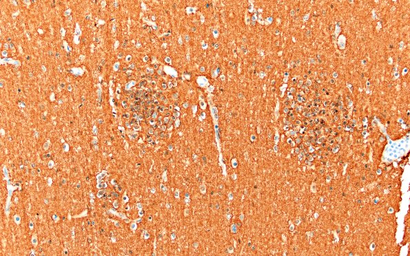 5M2 Malformation (Case 5) CD56 20X 2