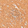5M3 Malformation (Case 5) CD56 40X 1
