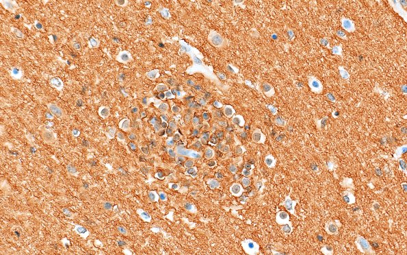 5M3 Malformation (Case 5) CD56 40X 1