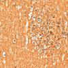 5M4 Malformation (Case 5) CD56 40X 3