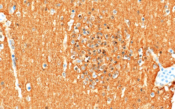 5M4 Malformation (Case 5) CD56 40X 3