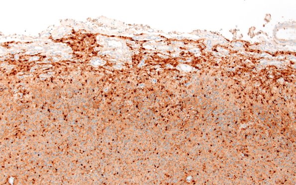 5N1 Malformation (Case 5) S100 10X 2