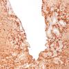 5N2 Malformation (Case 5) S100 10X