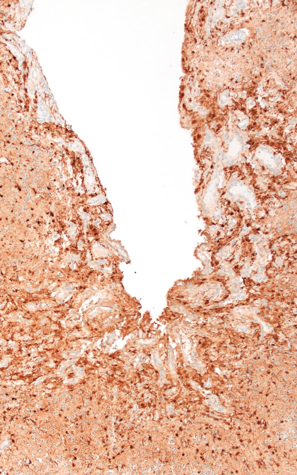 5N2 Malformation (Case 5) S100 10X