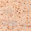 5N3 Malformation (Case 5) S100 20X 1