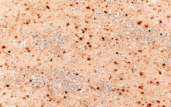 5N3 Malformation (Case 5) S100 20X 1
