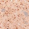 5N4 Malformation (Case 5) S100 20X 2